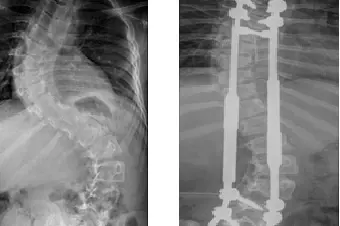 Røntgenbilder av skjev rygg uten vekststenger og med vekststenger
