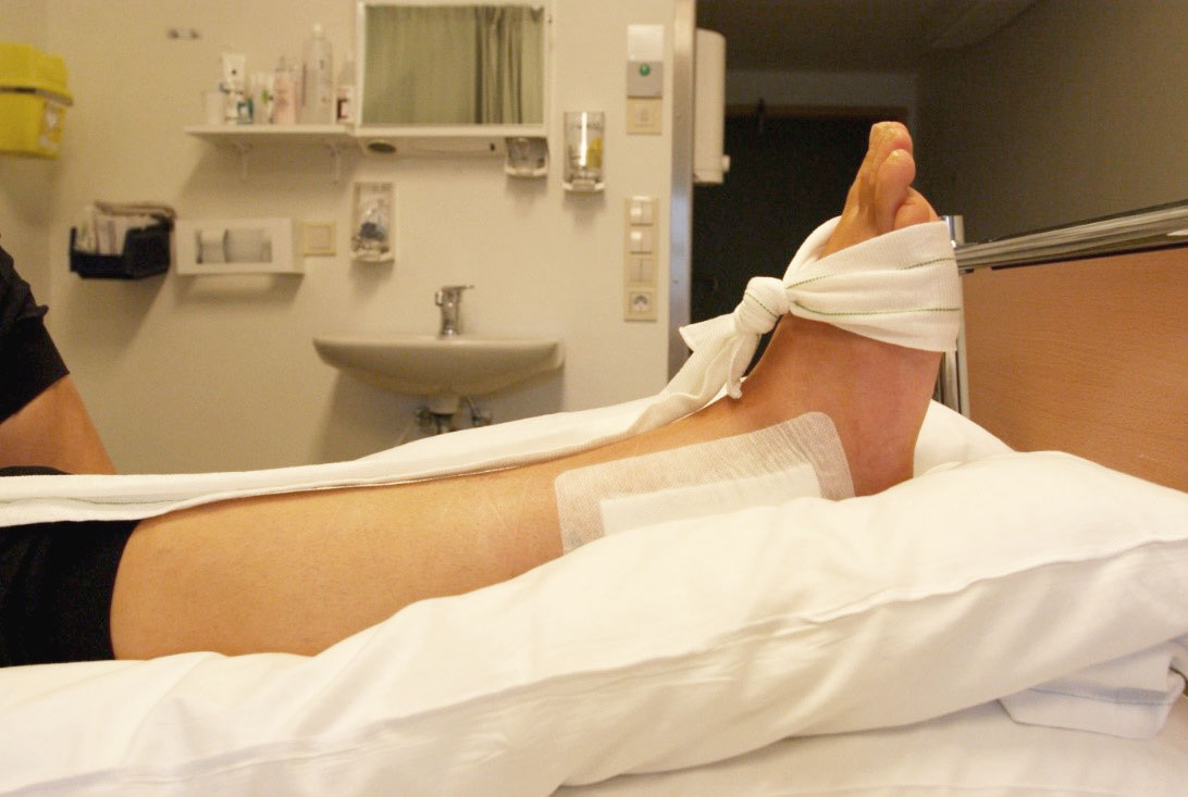 Fot med operert ankelledd og slakt bånd. Foto