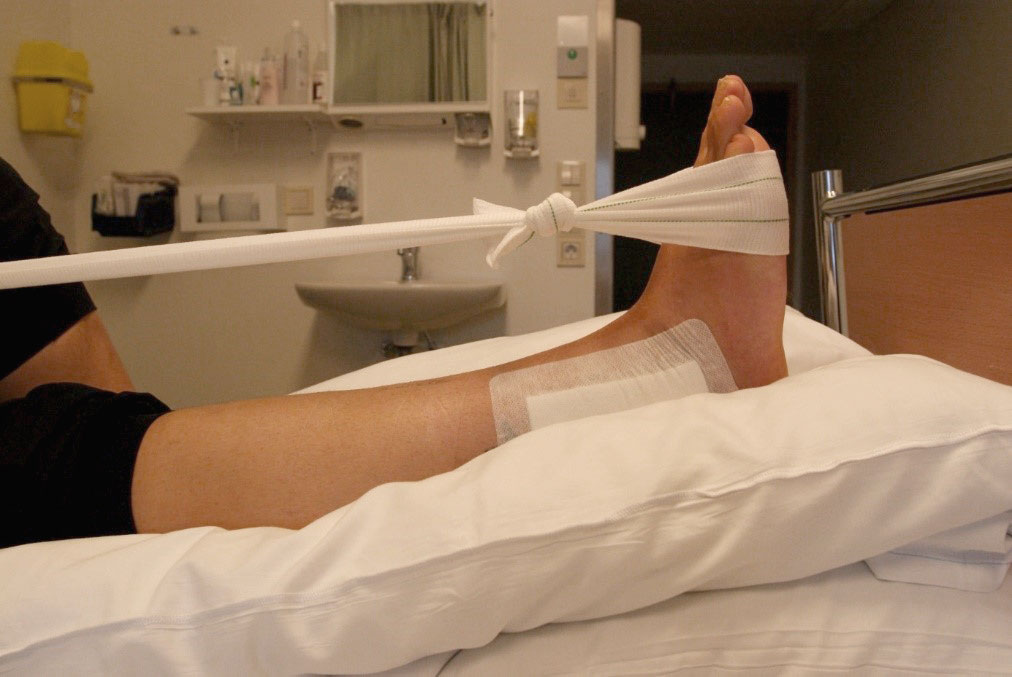 Fot med operert ankel og stramt bånd. Foto