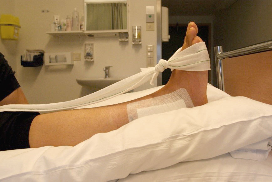 Fot med operert ankel som er bøyd og slakt bånd. Foto