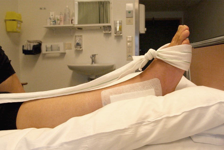 Fot med operert ankel i avslappet stilling. Foto