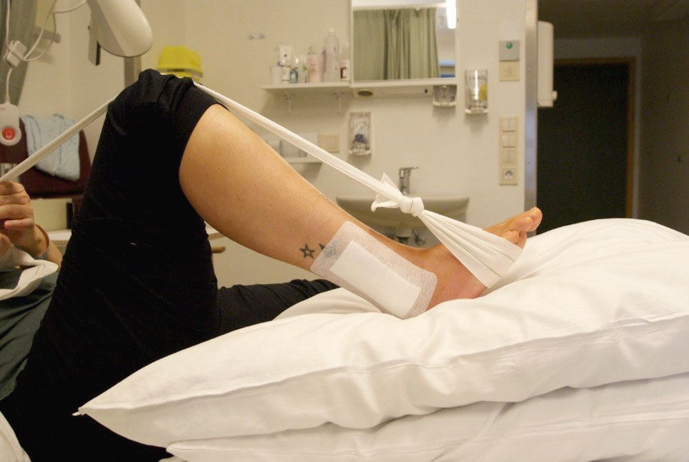 Fot med operert ankel og bøyd kne og strammet bånd. Foto