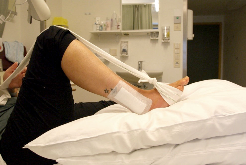 Fot med operert ankel og bøyd kne og delvis slakt bånd. Foto