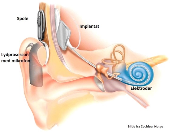 Tegnet illusrasjon av det indre øret med implantat
