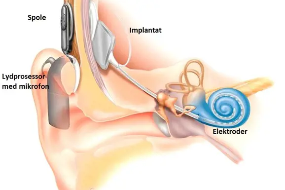 Tegnet illusrasjon av det indre øret med implantat