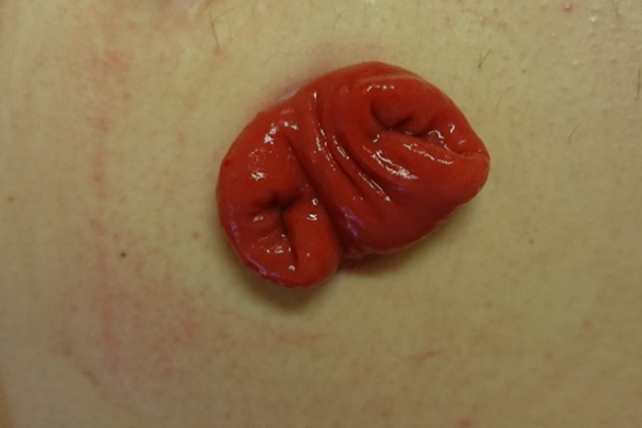 To løpet transversostomi