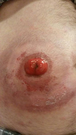 Et nærbilde av en persons hud med rødt utslett