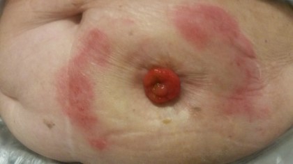 Et nærbilde av en persons hud