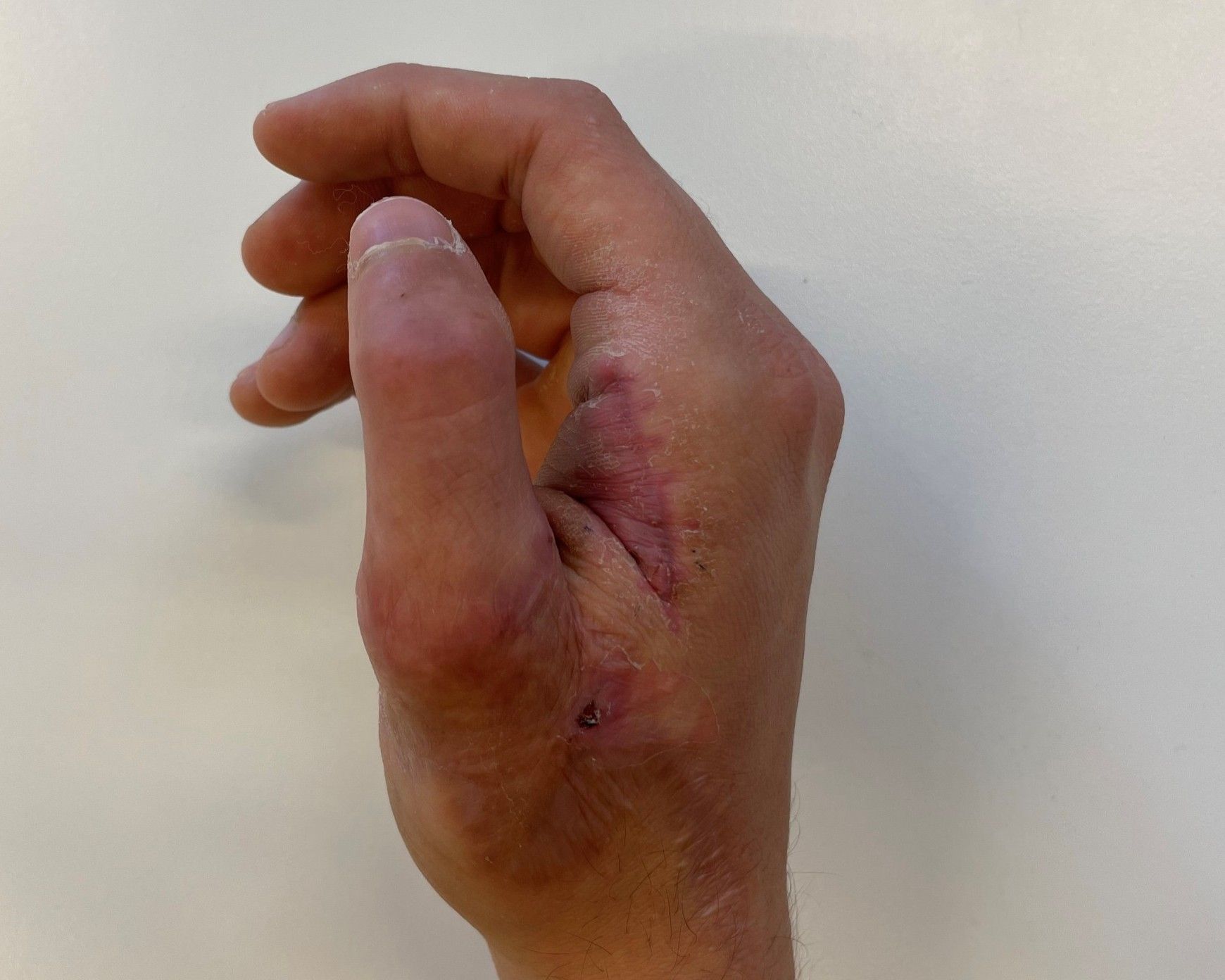 En hånd med tommel som er sydd etter skade