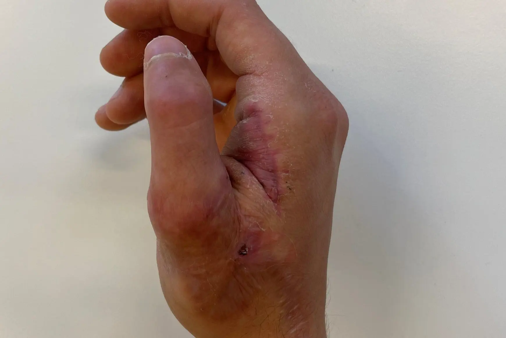 En hånd med tommel som er sydd etter skade